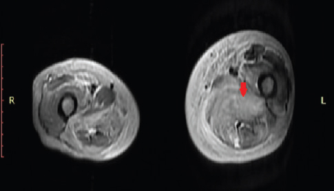 MRI T2W Axial revealed edema in left thigh and focal enlargement and hyperintensity in the left adductor muscles (red arrow).